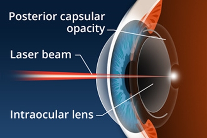 Diagram of laser procedure of the eye 