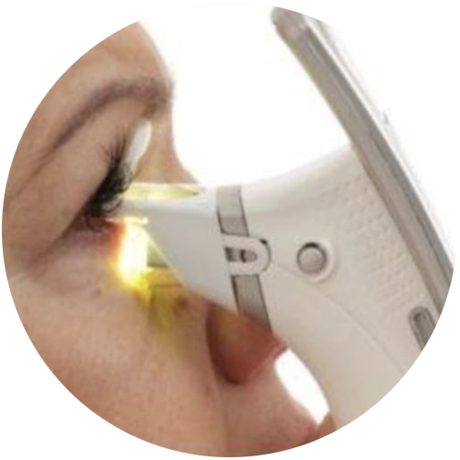 iLux Treatment for Dry Eye Gulf Coast | ILux Mobile Alabama