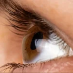 Human eye with keratoconus