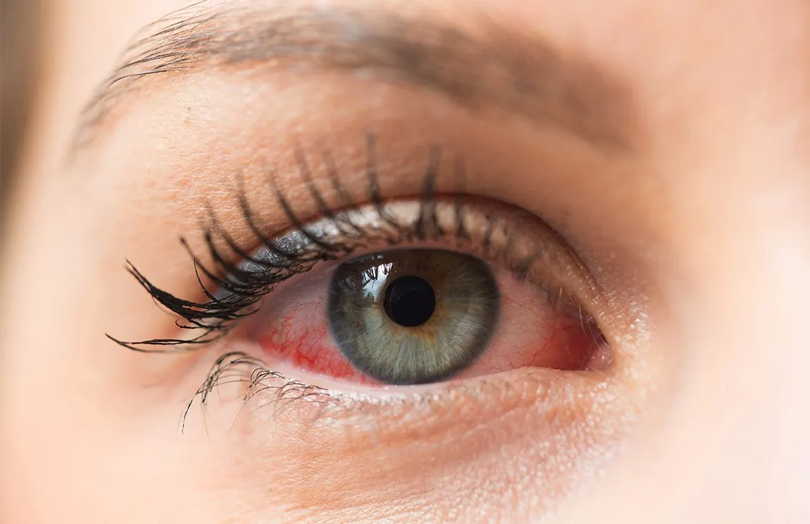 Closeup of eye with pinkeye