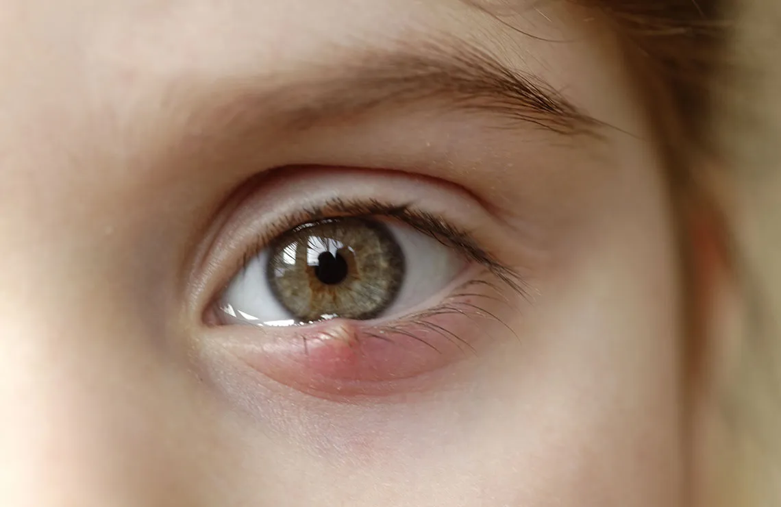 Closeup of eye with a stye