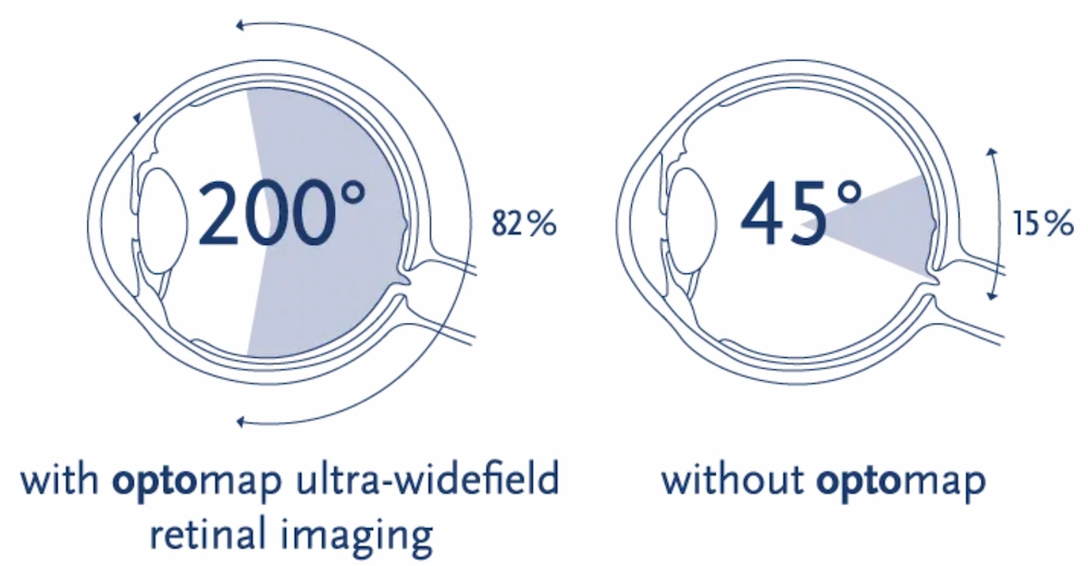 diagram of optomap digital retinal imaging compared to traditional imaging 